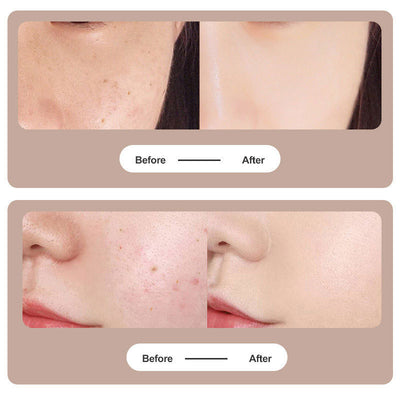 Tattoo Mole Removal Plasma Pen Laser Facial Freckle Dark Spot Remover Tool Wart.