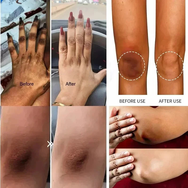Brightening Cream For Dark Skin Effective Lighten Thigh Inner Bleach Remove.