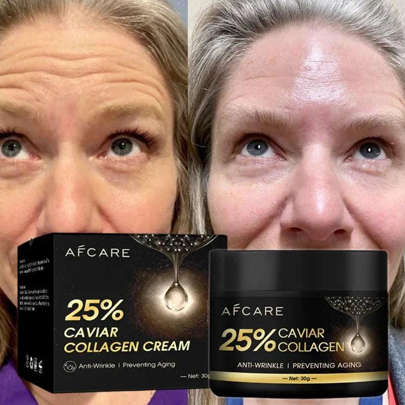 Before and after comparison of woman's forehead showing reduced wrinkles using Afcare 25% Caviar Collagen Cream anti-wrinkle face cream