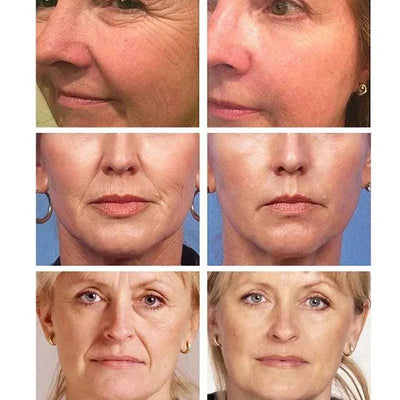 Before and after photos showing reduced facial wrinkles and improved skin firmness using Caviar Wrinkle Remover face cream with collagen eye mask.
